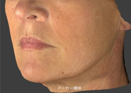 SUNEKOS-5-before-after-4-sessions-age45-65a