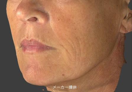 SUNEKOS-5-before-after-4-sessions-age45-65b